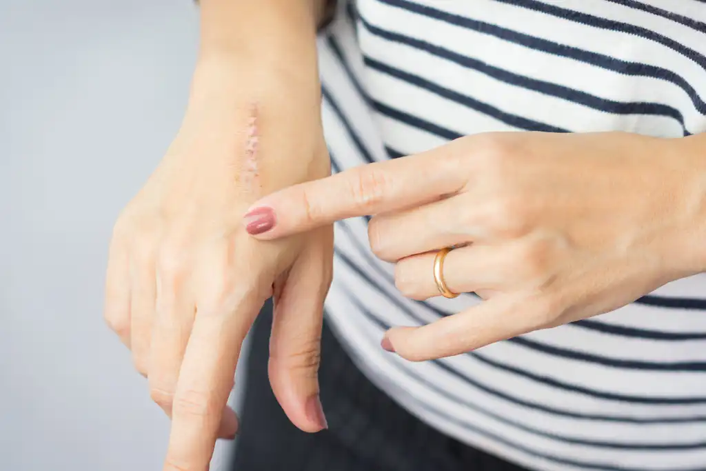 Narbenbehandlung Narbenbehandlung
